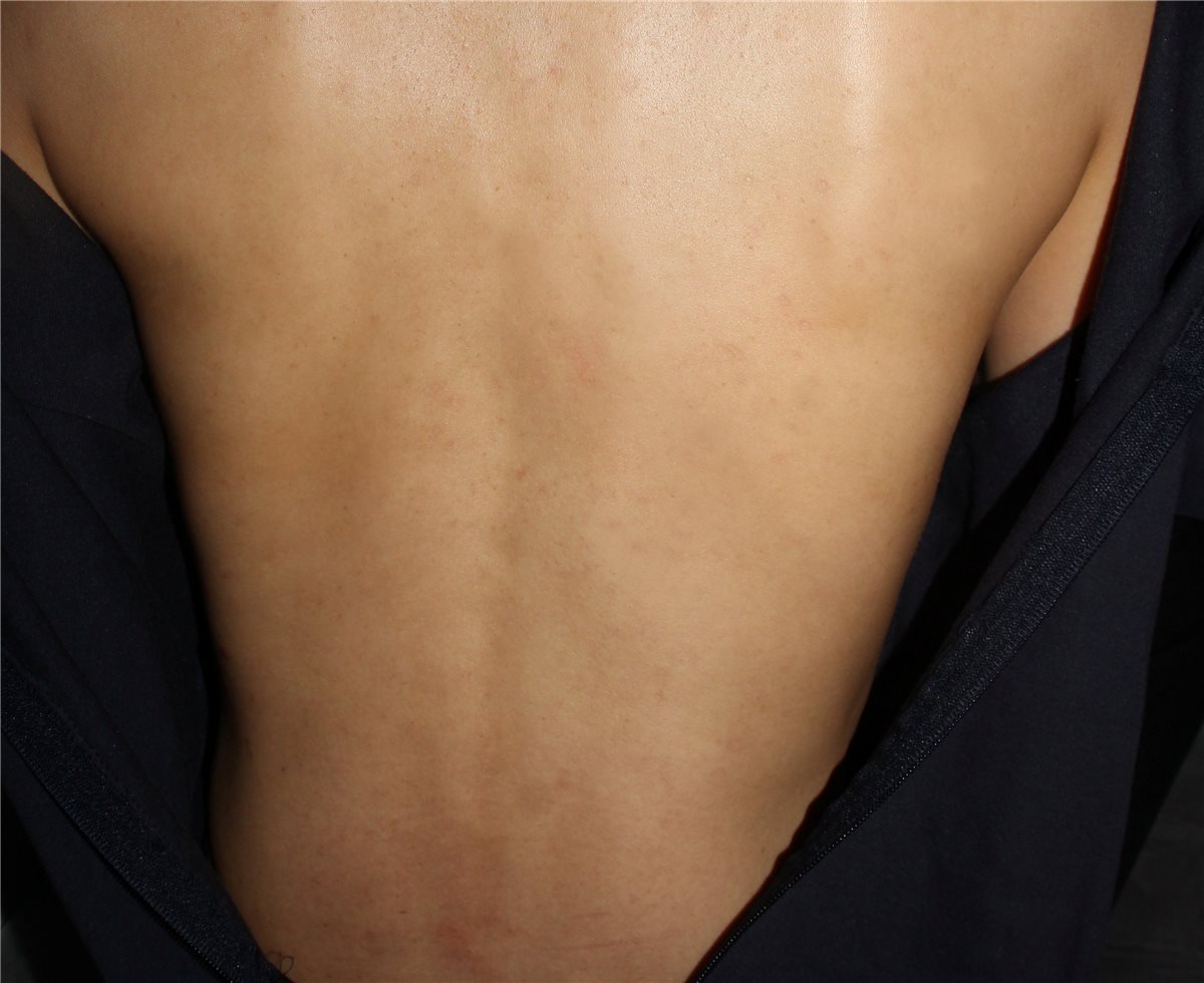 등 편평사마귀 치료 후